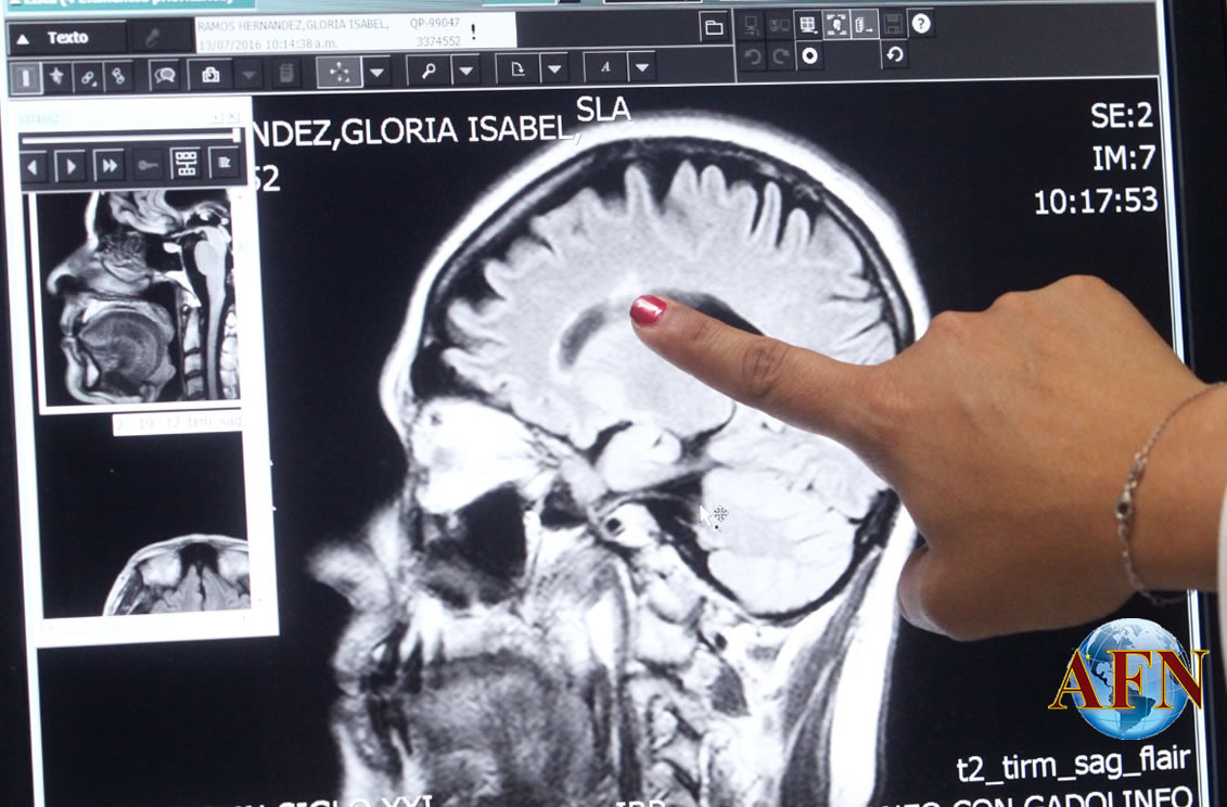Atienden en IMSS a pacientes con esclerosis