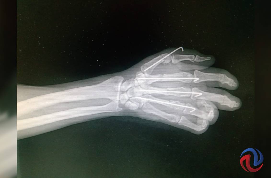 Salvó su mano derecha gracias a médicos del IMSS