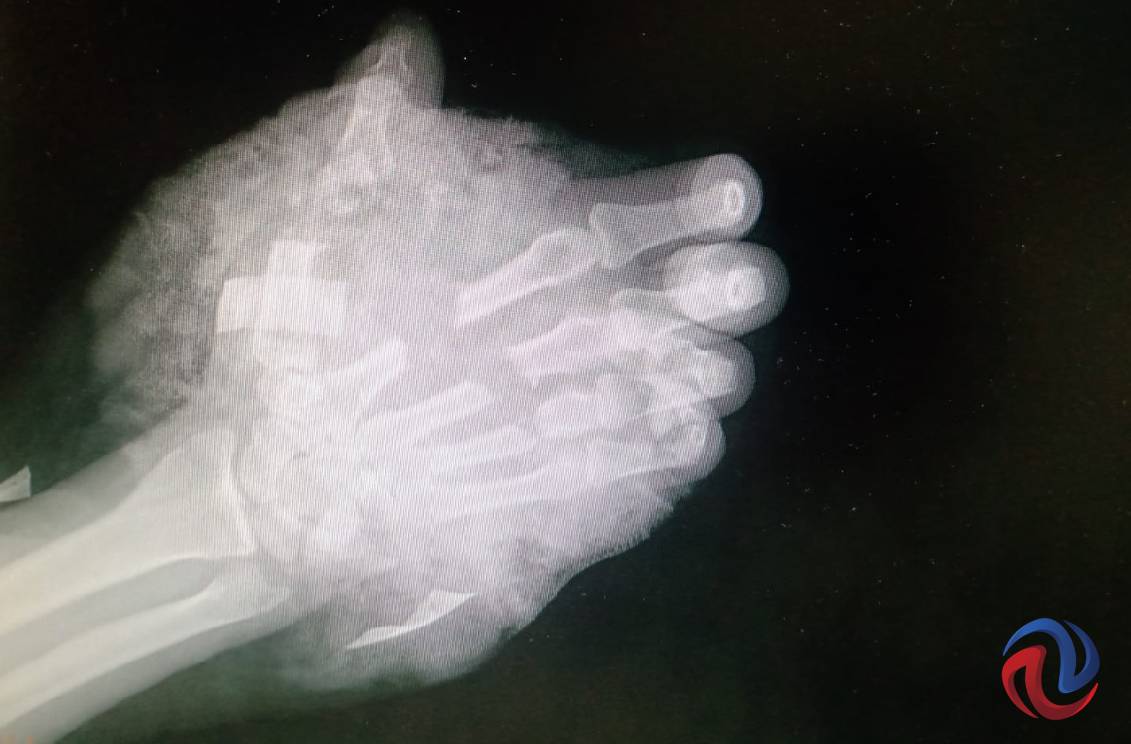 Salvó su mano derecha gracias a médicos del IMSS
